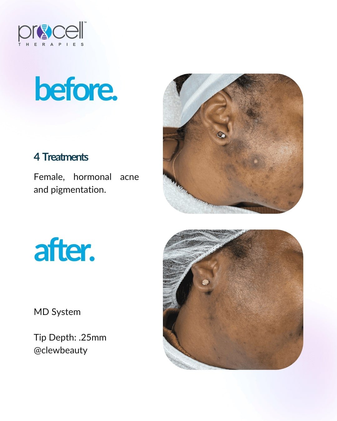 HYPERPIGMENTATION